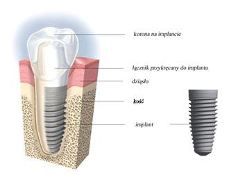Implant osadzony w kości. Implanty zębów w Piotrkowie.